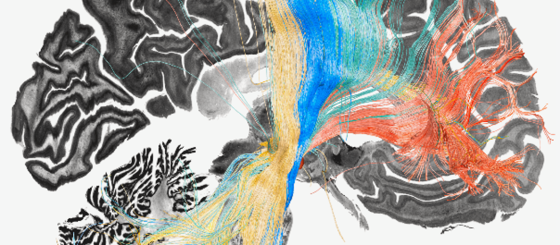 Using deep brain stimulation to map dysfunctional brain circuits linked to four disorders