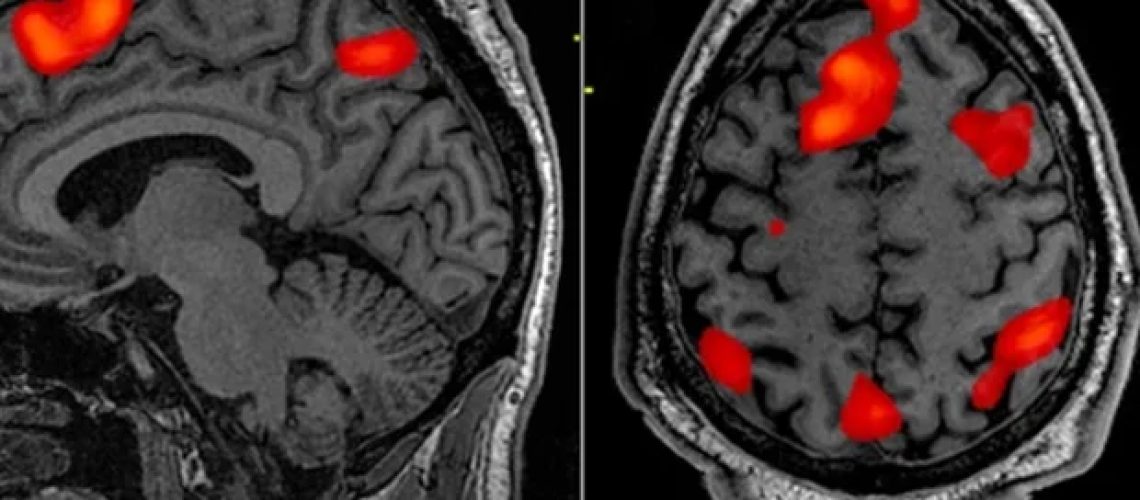 שינויים מבניים מוחיים הקשורים ל-PTSD כרוני במגיבים של מרכז הסחר העולמי