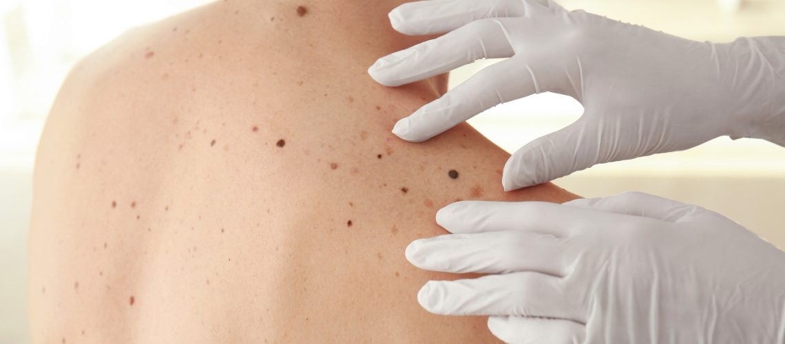 Study: Improving survival in advanced melanoma patients: a trend analysis from 2013 to 2021. Image Credit: Africa Studio/Shutterstock.com