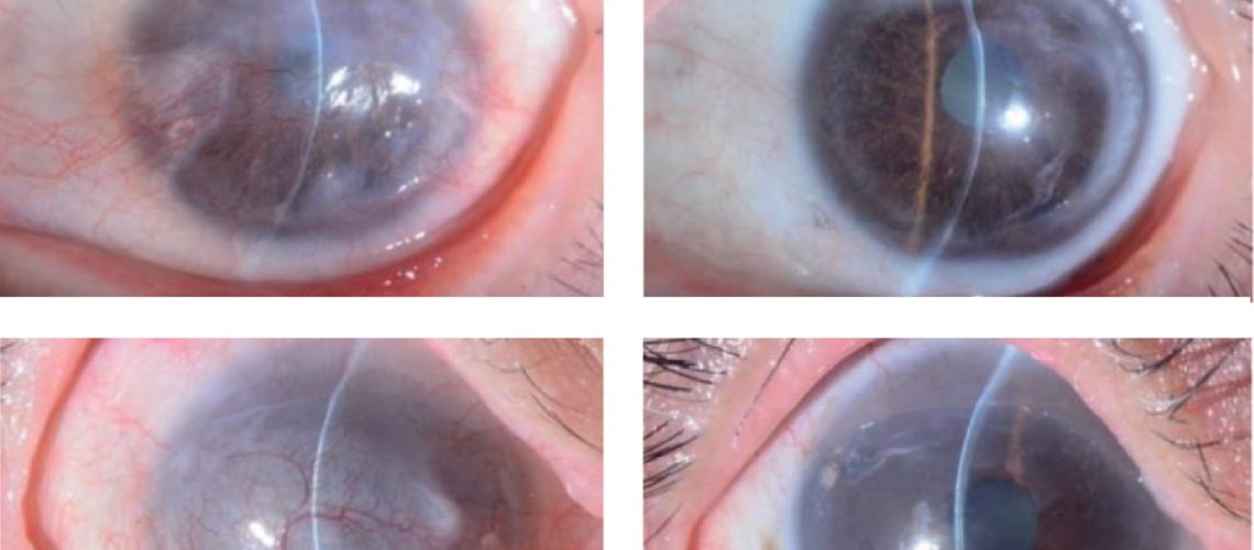 Slit-lamp microscopic photographs of all four treated eyes before and 52 weeks after induced pluripotent stem cell-derived corneal epithelial cell sheet transplantation