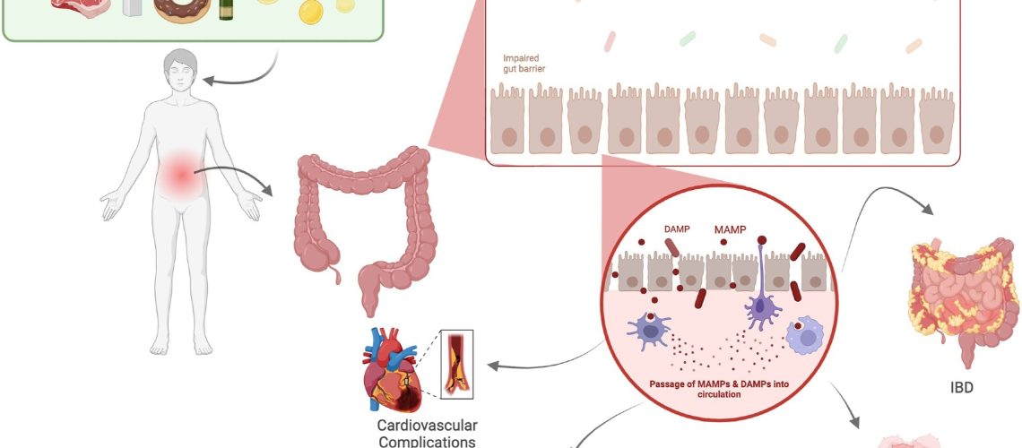 Study: The microbiome-driven impact of Western diet in the development of noncommunicable chronic disorders