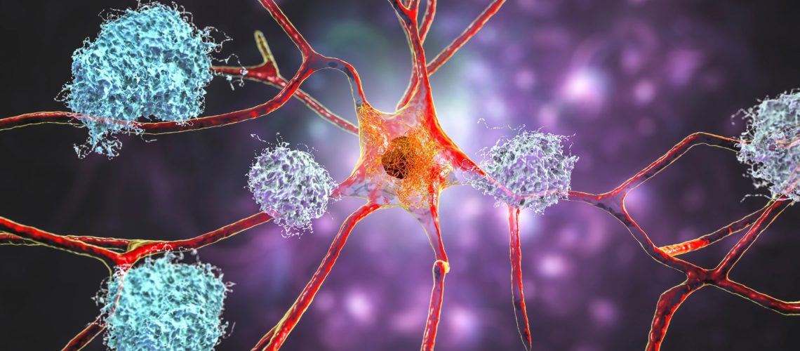 Study: Cell-type-directed network-correcting combination therapy for Alzheimer’s disease. Image Credit: Kateryna Kon / Shutterstock